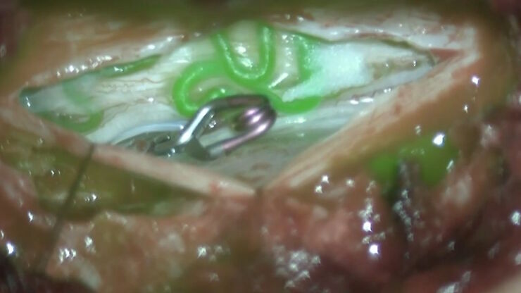 Augmented Reality fluorescence supports each step of neurovascular surgery procedures. Image courtesy of Dr. Christof Renner. Augmented Reality fluorescence supports each step of neurovascular surgery procedures. Image courtesy of Dr. Christof Renner.
