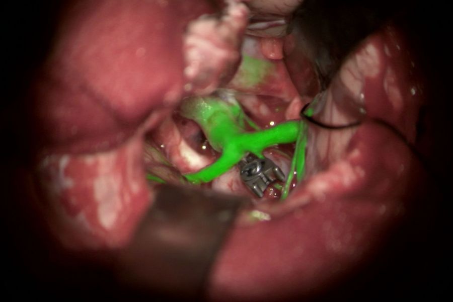 GLOW800 in aneurysm repair GLOW800 fluorescence brain aneurysm repair