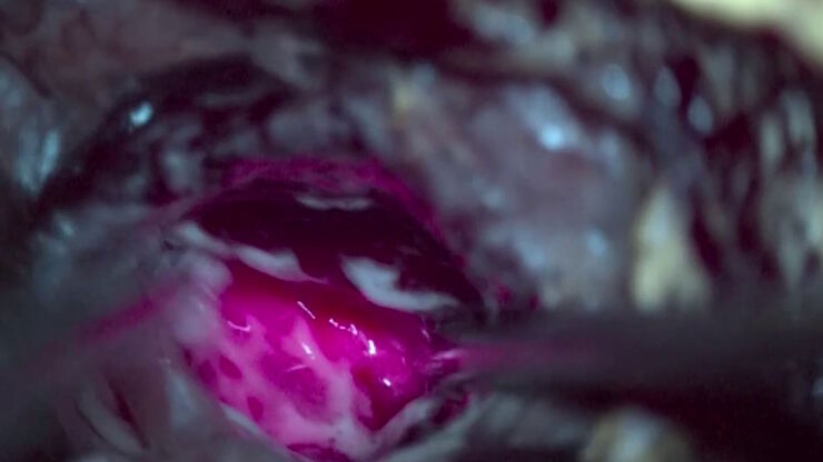 GLOW400 AR Fluorescence in anatomy view, image courtesy of Prof. Kondo GLOW400 AR Fluorescence in anatomy view, image courtesy of Prof. Kondo