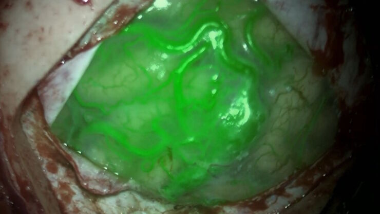 Use of GLOW800 Augmented Reality during AVM surgery. Image courtesy of Prof. Philippe Bijlenga. Use of GLOW800 Augmented Reality during AVM surgery. Image courtesy of Prof. Philippe Bijlenga.